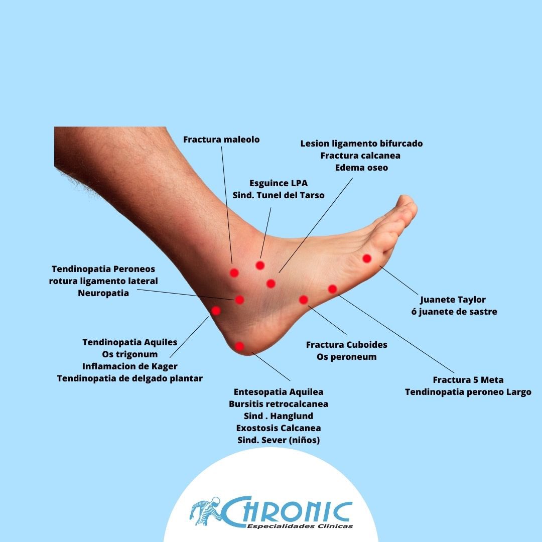 ChronicF's tweet photo. Conoces las patologías del pie más comunes y como las tratamos #pie #patologia #tratamiento #fisioterapia #podologia https://t.co/gArfGY7uhw