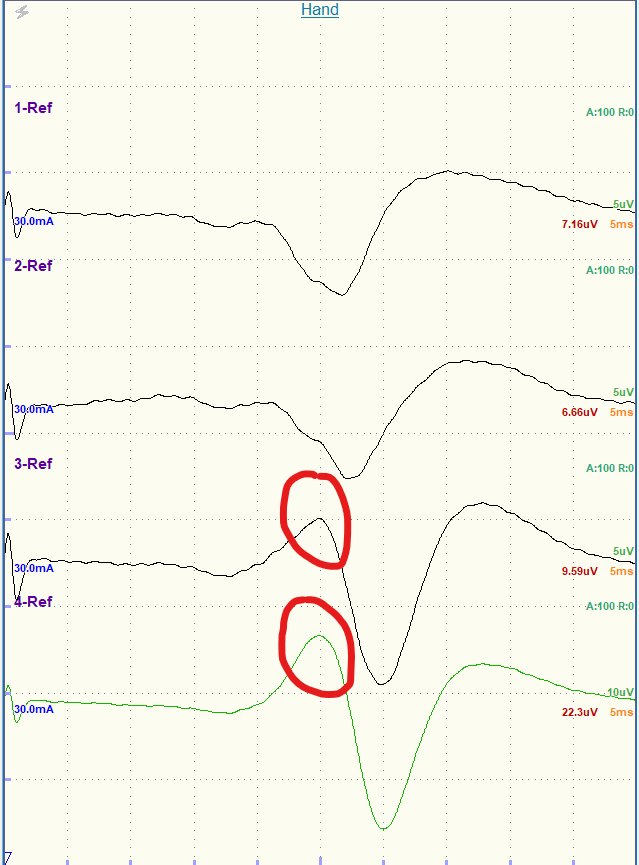 CwruEpilepsy's tweet photo. A 76 yo man is undergoing a craniotomy for tumor resection. Attached are the samples showing median N. SSEPs recorded from scalp electrodes and then using a 1x4 ECOG strip directly from the surface of the right brain. #EEG #EvokedPotentials #IOM #Neurophysiology #Neurotwitter https://t.co/j1SFwRtHuD