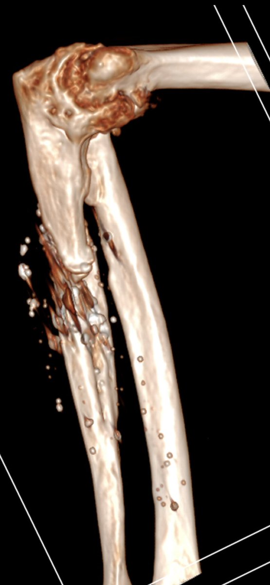 Displaced nonunion (pseudoarthrosis) of the proximal third of the ulnar shaft resulting from a guerrilla attack in Colombia in 1987, accompanied by multiple metallic foreign bodies indicative of shrapnel + severe tricompartimental arthritis. #Trauma #MedicalHistory”