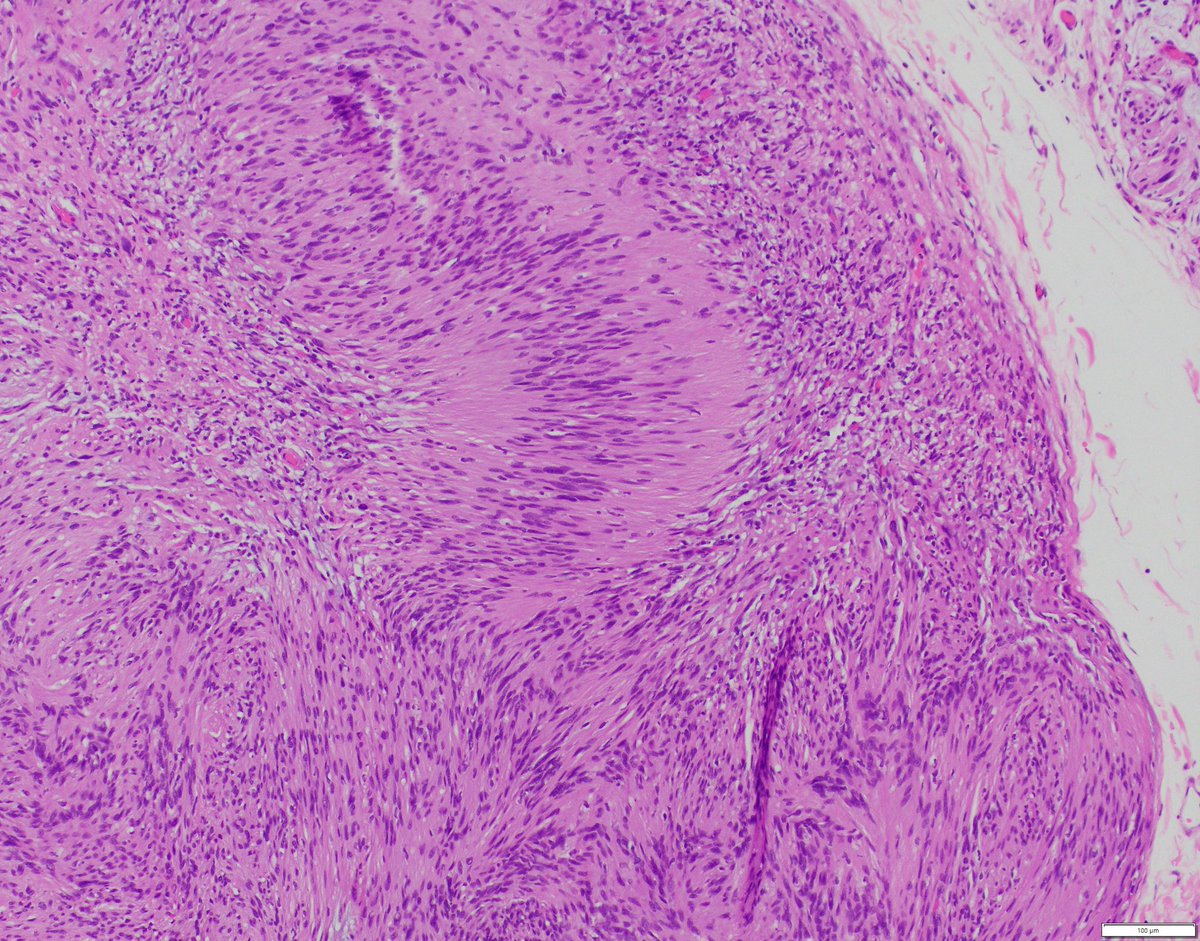 Plexiform schwannoma:
✅Benign peripheral nerve sheath tumor
✅usually solitary 
✅mostly sporadic
✅can occur in NF2 and schwannomatosis 
✅subcutaneous & predilection to limbs 
✅multinodular growth pattern 
✅nuclear palisades “Verocy bodies”
#PathTwitter #neuropath #bstpath