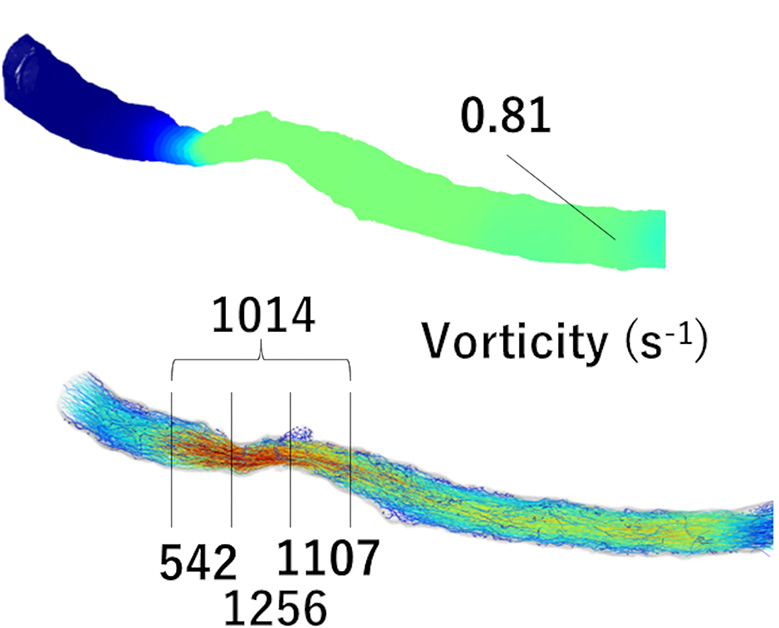 Radiology: Cardiothoracic Imaging (@radiologycti) on Twitter photo NEW PUBLICATION
📜Coronary Artery Vorticity to Predict Plaque Progression in Type 2 Diabetes
🔹Distal segment vorticity better predicts functional progression than high-risk plaque features and lesion length in pts with DM2 
⛓️doi.org/10.1148/ryct.2… NEW PUBLICATION
📜Coronary Artery Vorticity to Predict Plaque Progression in Type 2 Diabetes
🔹Distal segment vorticity better predicts functional progression than high-risk plaque features and lesion length in pts with DM2 
⛓️doi.org/10.1148/ryct.2…