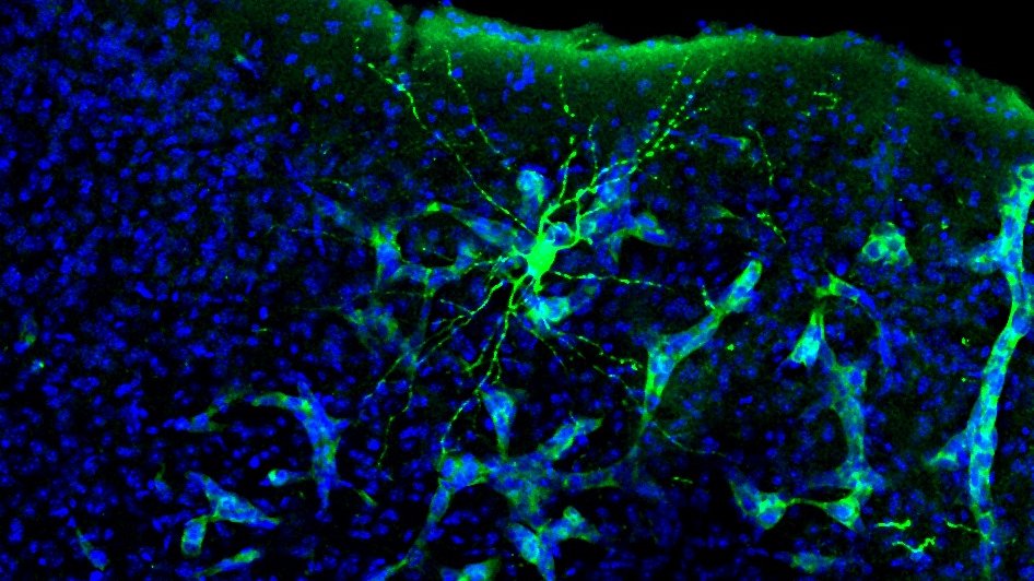 CSIC's tweet photo. Hasta ahora, se asumía que la metástasis afectaba a la capacidad cognitiva debido a que el tumor presiona el tejido neuronal, pero a menudo no hay relación entre tamaño del cáncer y cognición. La idea de que la metástasis altera la actividad cerebral supone un cambio de paradigma https://t.co/iHnVF2Upom