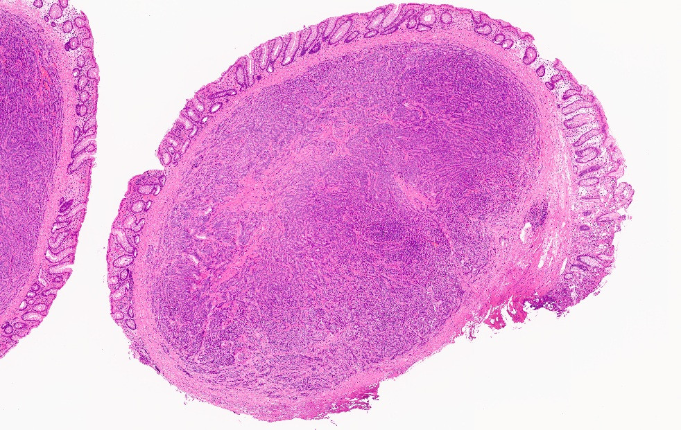 M59 y/o. polyp (5mm ) located 5cm from the anal margin. Adenoma or.....? More pics & Answer: kikoxp.com/posts/26411 More posts from Dr. Rey @ReyPathology kikoxp.com/severino_rey1 #pathology #pathTwitter #medTwitter #GIpath