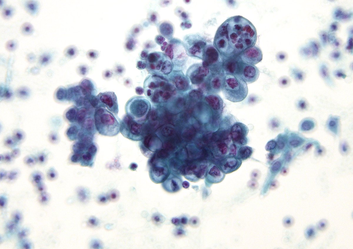 My “CASE of the week” for inhouse cyto signout, illustrating the remarkable phenomenon of how the “bag of polys” are recruited by the “endometrioid endometrial adenocarcinoma”, even at metastatic sites. This case is an abdominal fluid involved by the pt’s known EM CA.