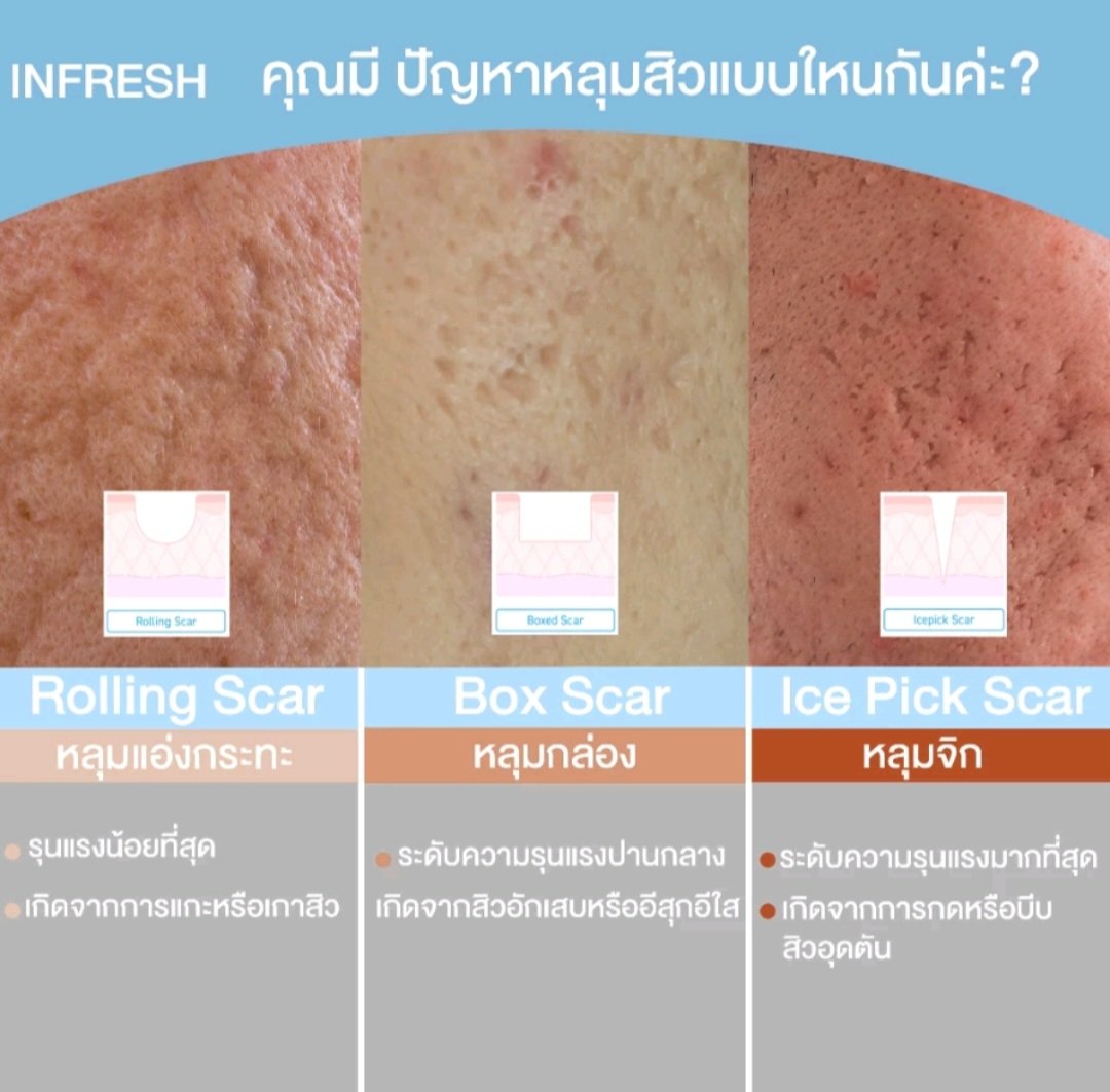 air_suda's tweet photo. #Infresh #เซรั่มหลุมสิว โปร 2แถม4  อินเฟรช ส่งจากบริษัทโดยตรง ขายในราคา ฿990 
#แถมฟรี #เซรั่ม #หลุมสิว
 📌https://t.co/VAoATfHYzx https://t.co/SIpzxjBosG