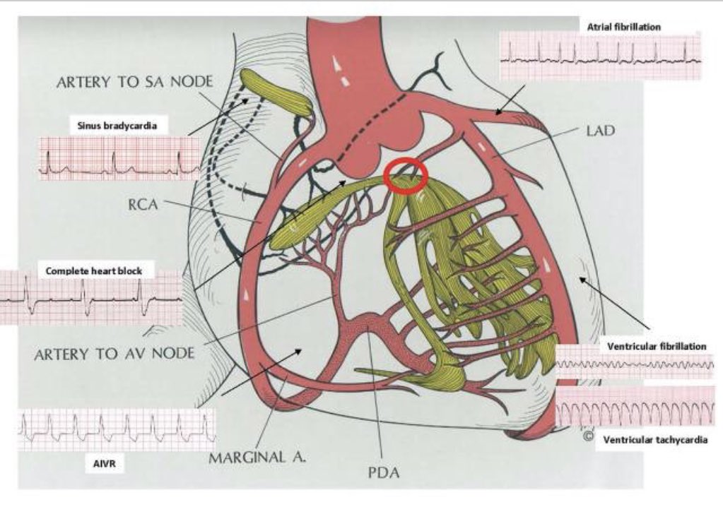 🫀 Arrhythmias After Acute Myocardial Infarction #Cardioed #Cardiology #Epeeps #ENARM