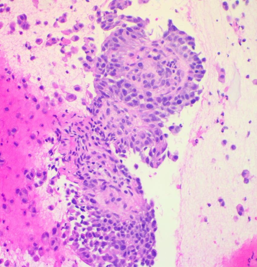 Metastatic LUNG lesion- 
There is history of Papillary Urothelial Carcinoma. 
Seen are the “Cercariform” cells with cytoplasmic tails described in urothelial carcinoma. 
#path #PathTwitter #cytology #cytopath #surgpath