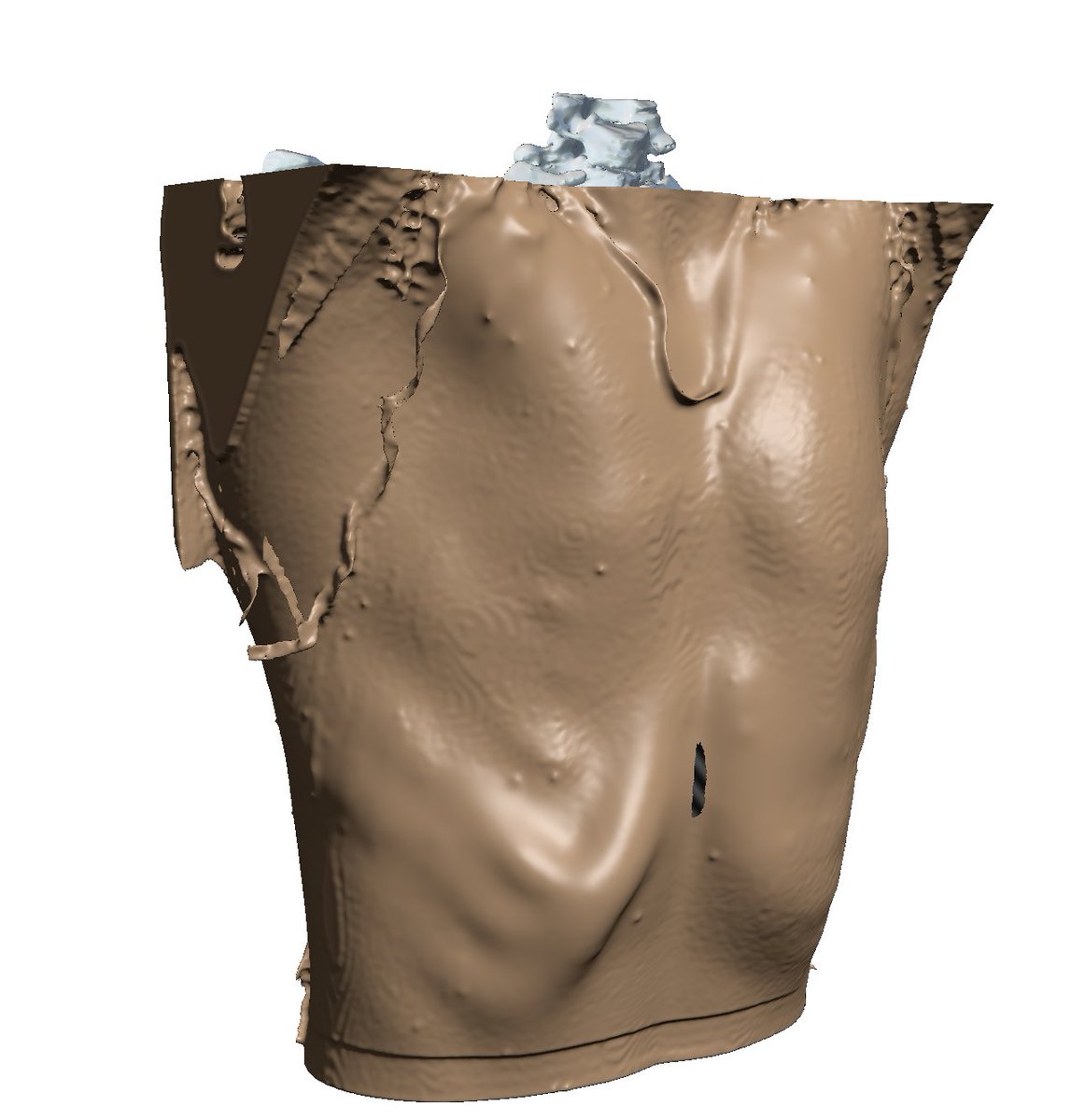 FabLab 3D Hospital Marañón (@3d_maranon) on Twitter photo Virtual anatomical 3D model (CMD Class I) for surgical planning in a pediatric patient with Poland Syndrome, reducing risks and intervention time. Collaborative clinical-engineering work.
<a href="/3d_maranon/">FabLab 3D Hospital Marañón</a> <a href="/rupermac/">Rubén Pérez-Mañanes, MD PhD</a> <a href="/calvoharo_ja/">José Antonio Calvo</a> #UPAM3D #HospitalGregorioMarañon #impresion3D Virtual anatomical 3D model (CMD Class I) for surgical planning in a pediatric patient with Poland Syndrome, reducing risks and intervention time. Collaborative clinical-engineering work.
<a href="/3d_maranon/">FabLab 3D Hospital Marañón</a> <a href="/rupermac/">Rubén Pérez-Mañanes, MD PhD</a> <a href="/calvoharo_ja/">José Antonio Calvo</a> #UPAM3D #HospitalGregorioMarañon #impresion3D