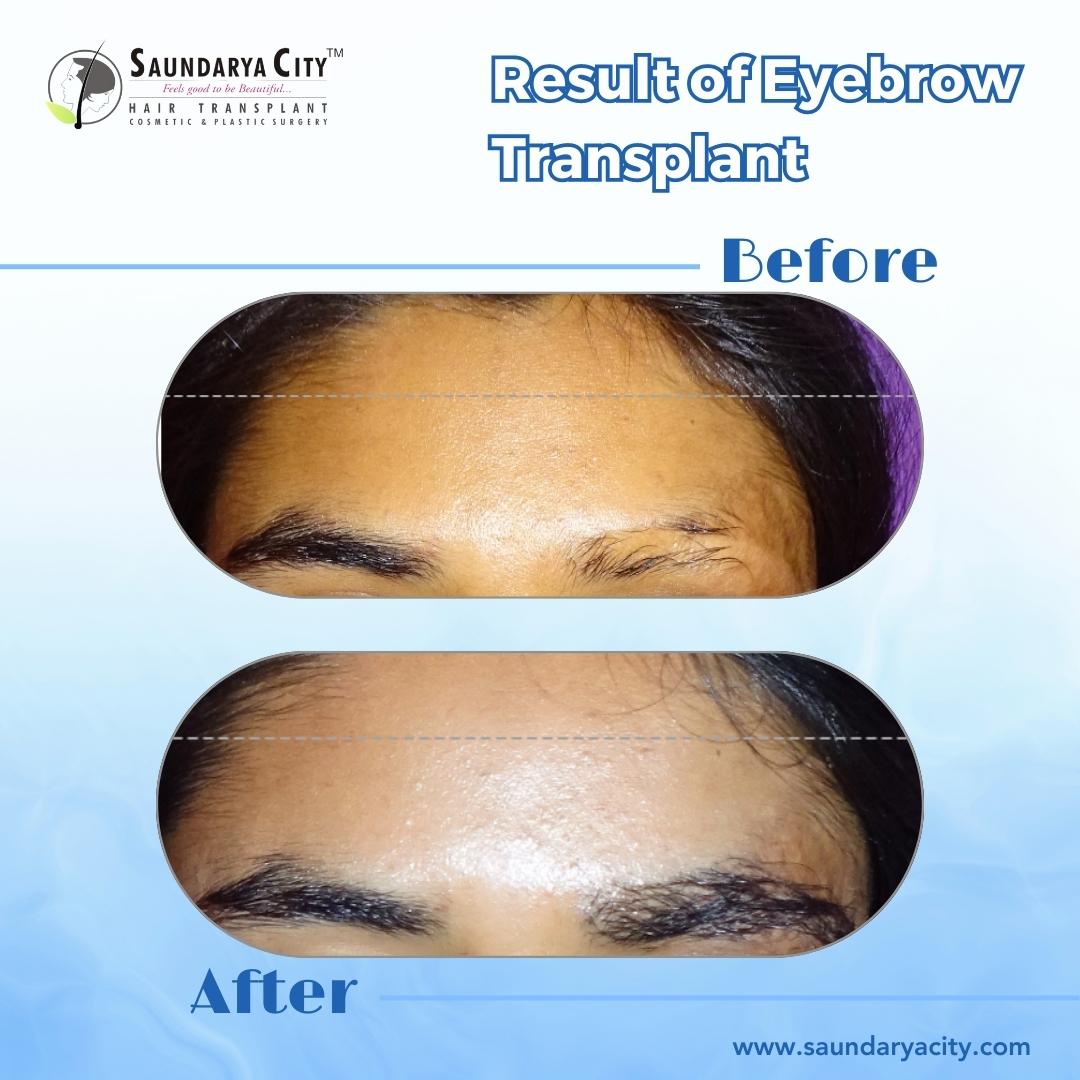 Embrace Confidence, One Strand at a Time! Explore the breathtaking before and after results of our Eyebrow Transplant procedures by Dr. Suresh Chaware. #eyebrowtransplant #hairtransplant #eyebrow #BrowConfidence #hairtransplantation #hairtransplant #hairloss #haartransplantation