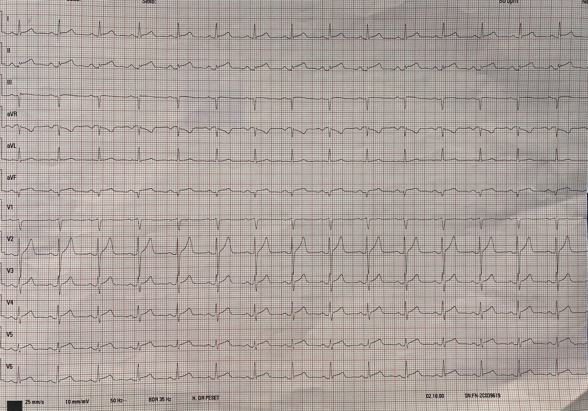 47 👨🏻 with short episodes of atypical CP. COVID infección 2 weeks ago. Two days of fever (38º) without known focus. First TnI determination of 1100pg/mL and 1700 3h later. What do you think? <a href="/EcgsOnly/">ECGs</a> <a href="/smithECGBlog/">Stephen W. Smith</a> <a href="/RobertHermanMD/">Robert Herman, MD, PhD</a> <a href="/PendellM/">Pendell Meyers</a>