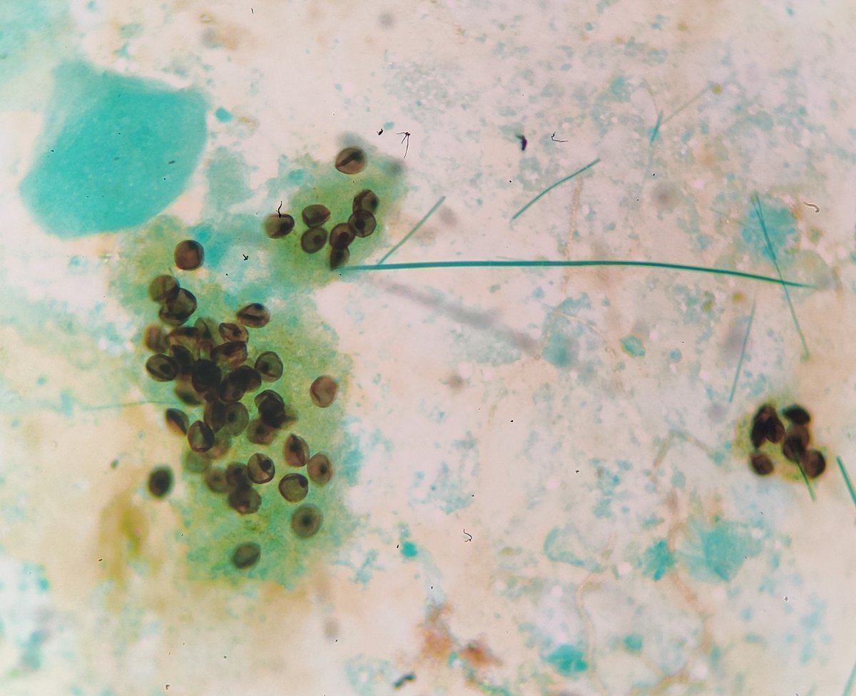 Brocho alveolar Lavage fluid -Silvsr stain #cytology #PathTwitter #pneumocystis #pathclassics