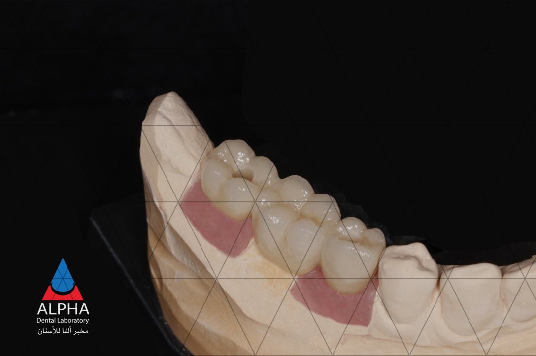 ✨ Alpha , 3-unit Screw-Retained Bridge over 2 Implants! 

🦷 Precision Fit
🎨 Natural Aesthetics
💪 Durability

Experience the future of dental perfection! 😁