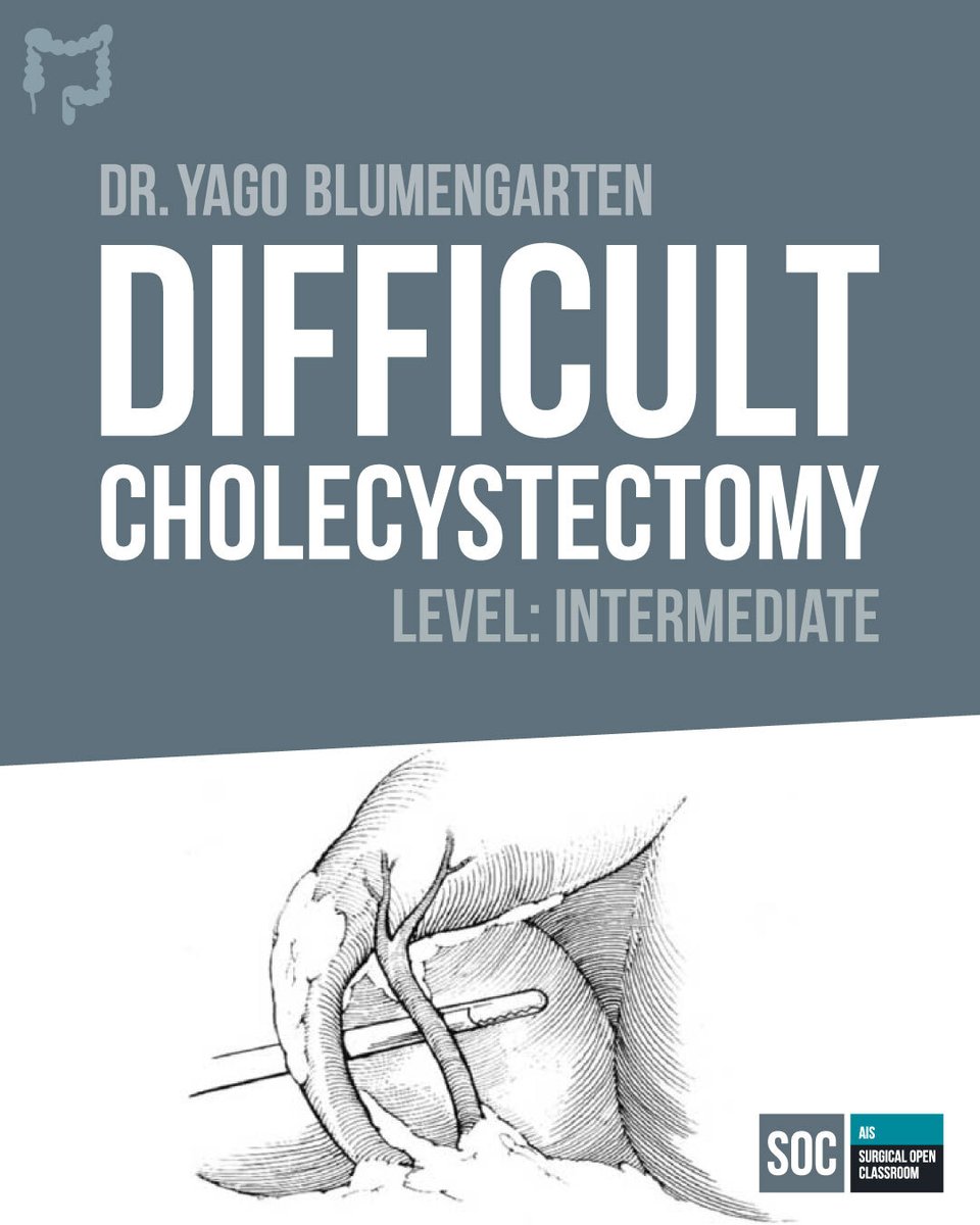 📌Calling all medical professionals! 🏥 Join us for an insightful #SurgicalOpenClassroom 'Difficult Cholecystectomy' with @YagoBlumen from @SColegiales. Let's spread the word about this FREE training opportunity! 📢 aischannel.com/society/diffic… #IamAIS #Some4surgery