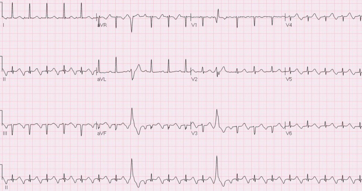 DrJayMohan's tweet image. EKG test!

70 year old with palpations! Name the 5 major finding on this EKG! 

1)
2)
3)
4)
5)

#MedicalEducation #Meded #ecgchallenge #Medicalschool #cardiology #cardiologia #heart  #nursing #usmle #MCAT #premed #hospital #Md #ekg #ecg