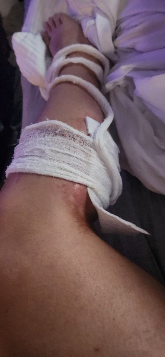 jmelee8's tweet photo. Day 3 after burns. First post. Gonna try dressing them myself cuz nobody is here to help and my kids need to go to school. https://t.co/uTF1XPFu23