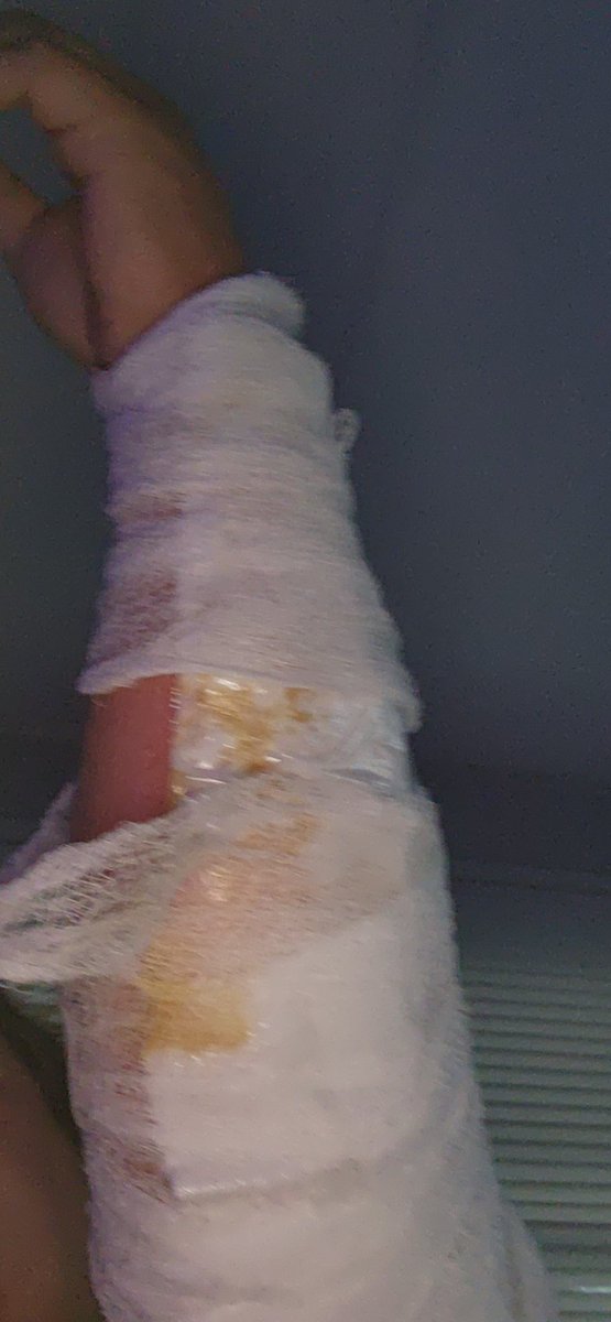 jmelee8's tweet photo. Day 3 after burns. First post. Gonna try dressing them myself cuz nobody is here to help and my kids need to go to school. https://t.co/uTF1XPFu23