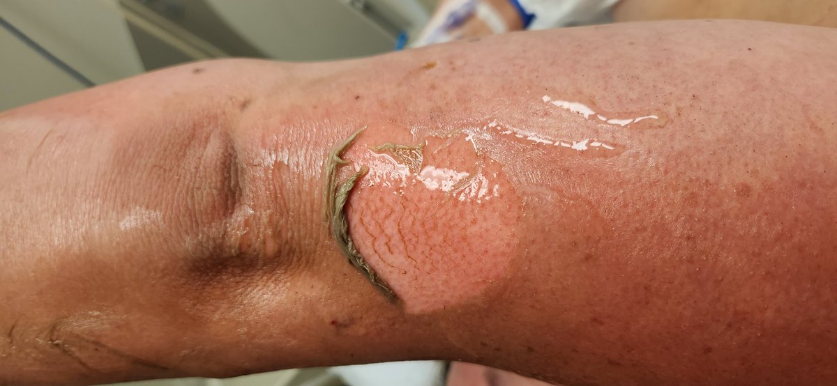 jmelee8's tweet photo. So this happened Saturday while camping. Wasn't aware there was a sunscreen aerosol can in the fire. I was next to it feeding it broken branches. https://t.co/jEiAXDqbXh