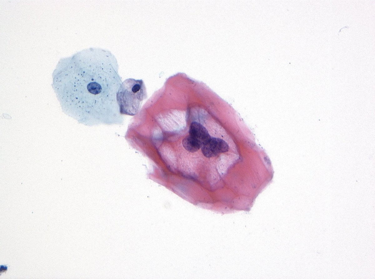 Happy cyto Tuesday!! With a gorgeous LSIL 🦋 #cytopath