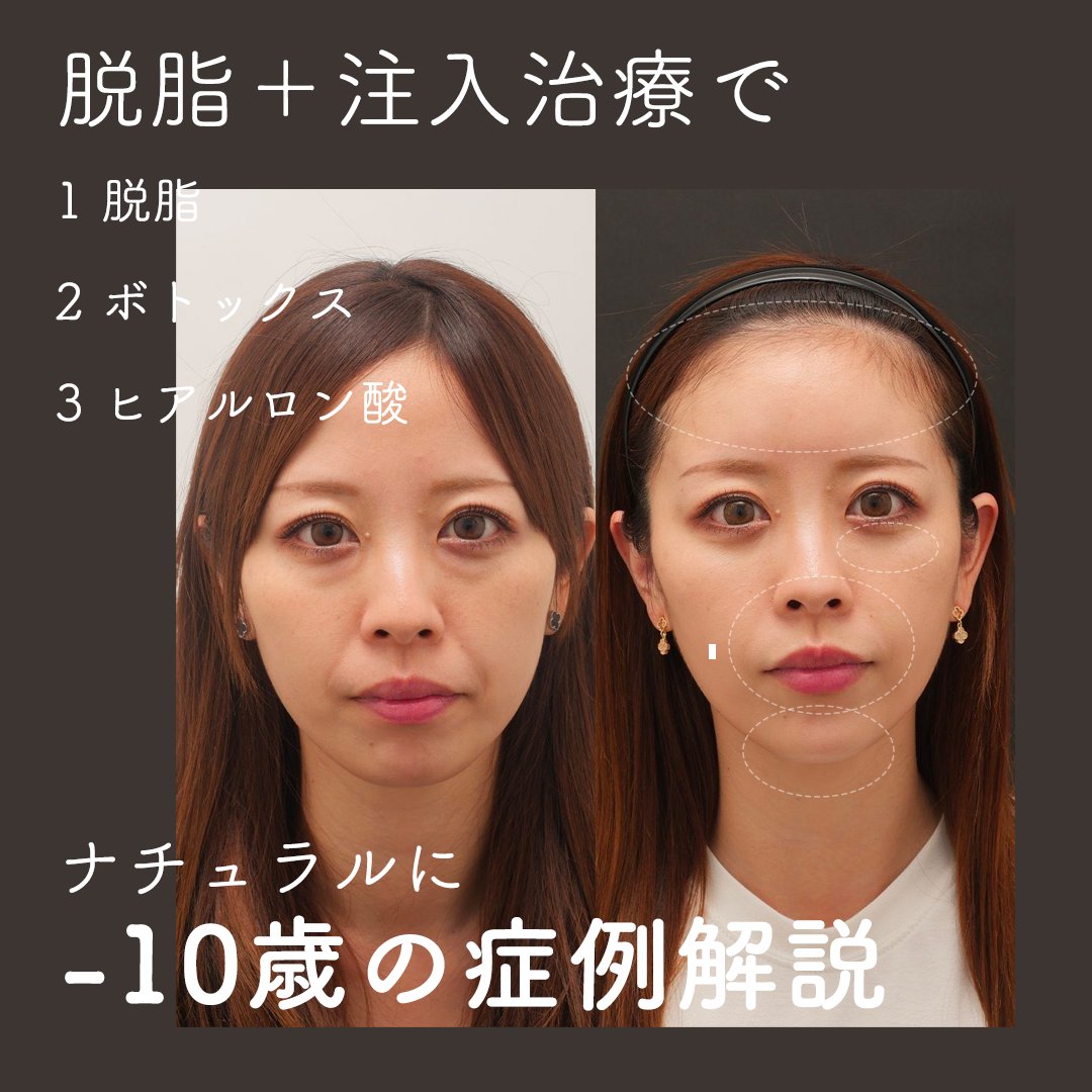 kiriko_isea's tweet image. 目の下のクマ取り(経結膜脱脂術)と注入治療の解説をしました。
▼注入治療の詳細▼
上唇鼻翼挙筋ボトックス
口角下制筋ボトックス
顎筋ボトックス
額ヒアルロン酸
鼻翼基部ヒアルロン酸
唇ヒアルロン酸
顎ヒアルロン酸
