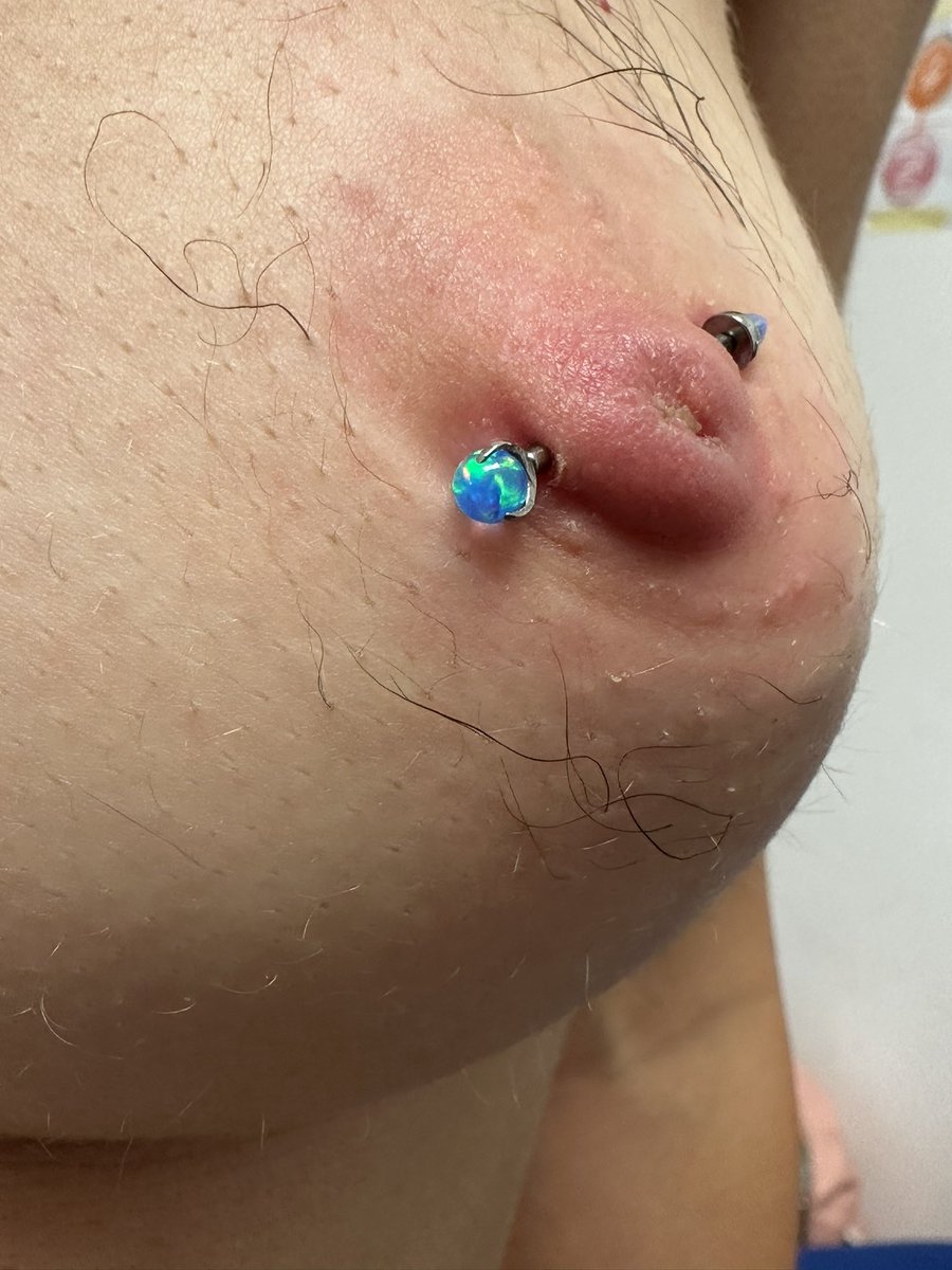 Peachy_piercer's tweet photo. Healed nipple piercing - inverted nipple
#nipple #nipplepiercing #femalenipple #femalenipplepiercing #freenipple #nipplefree #invertednipple https://t.co/fR2mfHxWLc