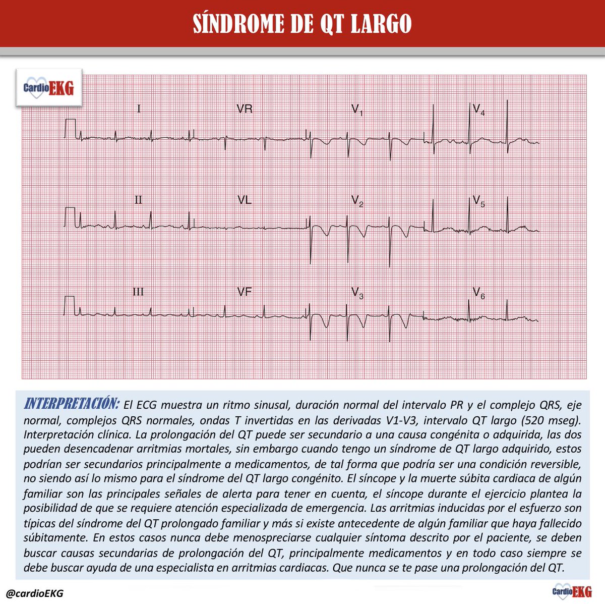 CardioEkg's tweet photo. Alguna vez has visto alteraciones del QT? https://t.co/b16rG2dNju