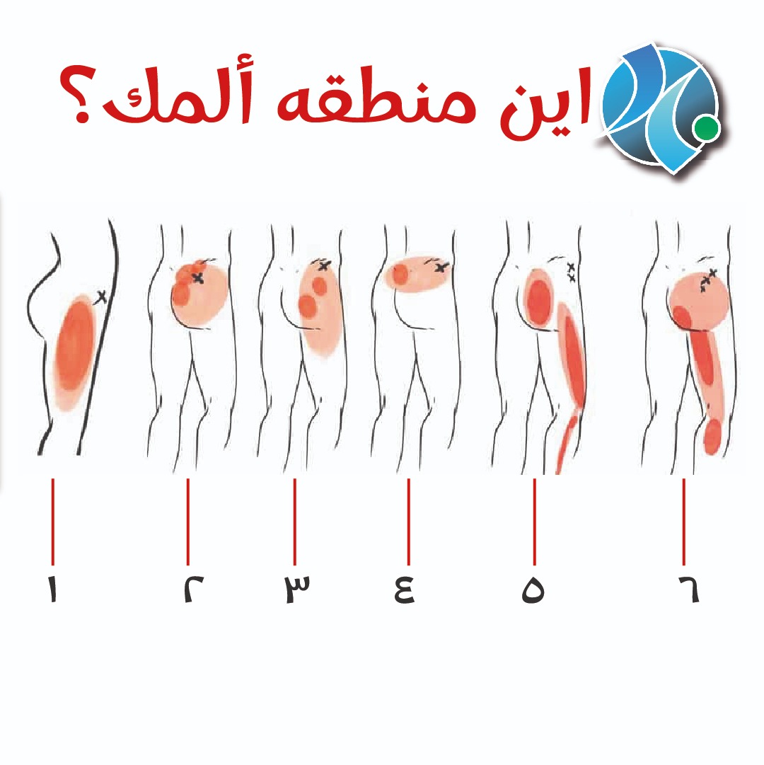 basemhenri's tweet photo. اين هي منطقه ألمك في الساق ؟
شاركنا بألمك و هنساعدك بطرق العلاج الغير جراحيه https://t.co/vwD1ko4vHb