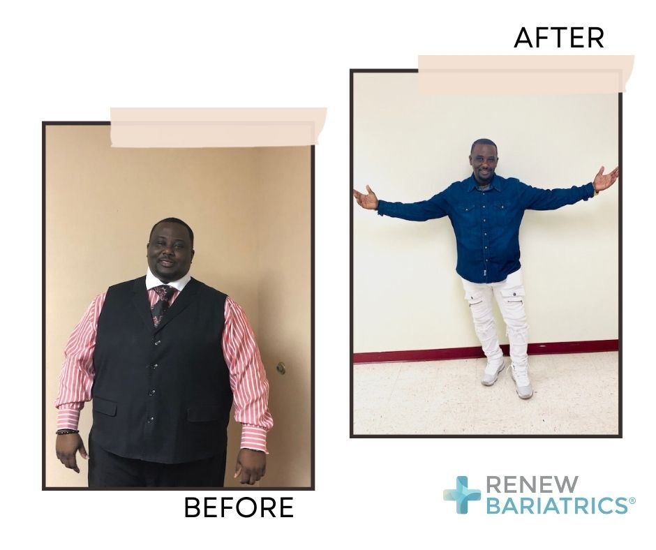 The results speak for themselves – he has embraced change and achieved remarkable weight loss milestones. Let this journey inspire you and remind you that positive change is possible. 🎉📷 #BariatricJourney #BeforeAndAfter #TransformationTuesday #vsgmexico #gastricsleeve