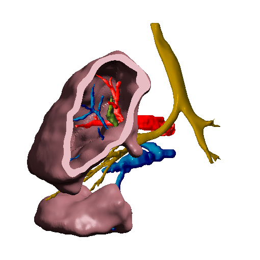 3D virtual reconstruction (CMD I) of the patient's anatomy in case of complex lung malformation allows to plan the surgery in advance and a more rigorous and adequate pediatric management
<a href="/3d_maranon/">FabLab 3D Hospital Marañón</a> <a href="/rupermac/">Rubén Pérez-Mañanes, MD PhD</a> <a href="/calvoharo_ja/">José Antonio Calvo</a> #UPAM3D #HospitalGregorioMarañon #impresion3D