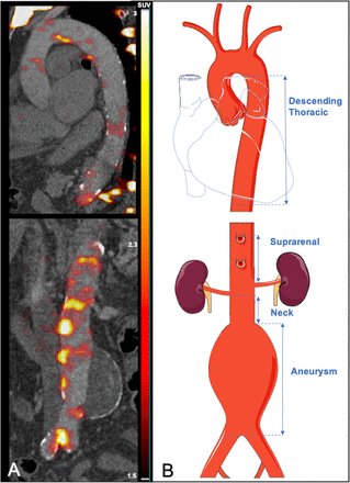 Aortic sodium [18F]fluoride uptake following endovascular aneurysm repair 🏥 bit.ly/459bRl0