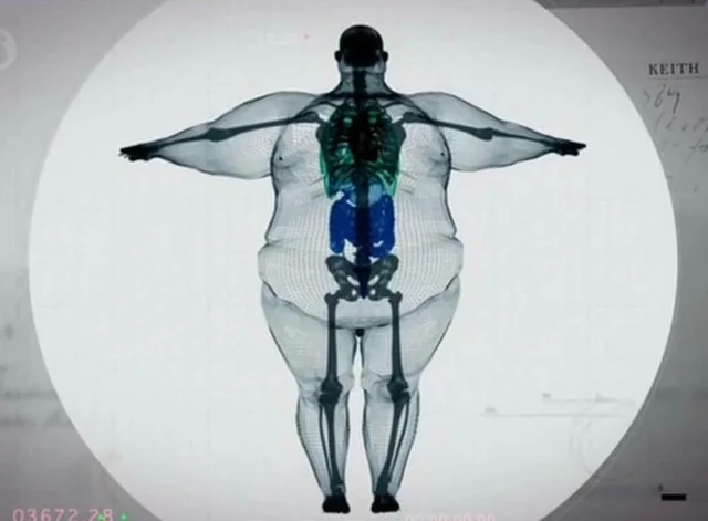 InsaneReality's tweet photo. The X-Ray of a 700 pound man https://t.co/Ld9E1nv2IO