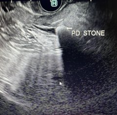 sepdigestiva's tweet photo. Lito en ducto pancreático- pancreatitis recurrente, tx c/LEH #Medical #GITwitter #MedTwitter #ERCP #pancreas #pancreatitis #advancedendo #AEF 🙂
Por cortesía de @MarijoRojasMD https://t.co/sKLSIWXXdB