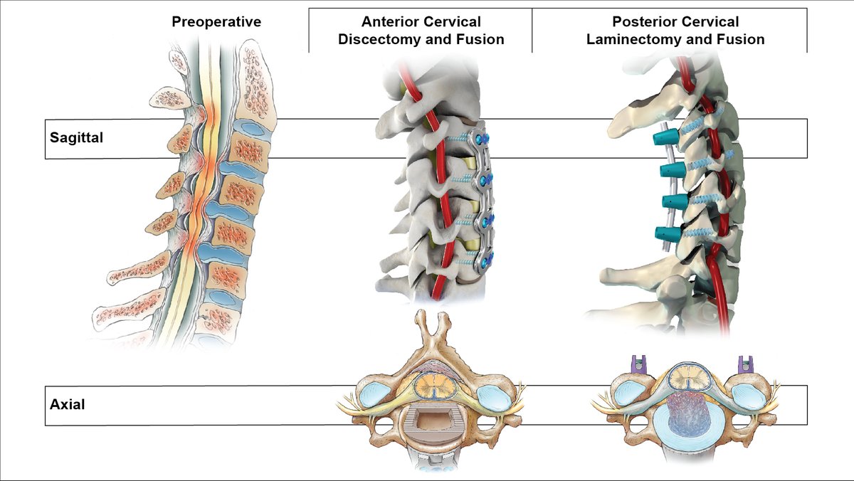In this month's issue of #NeurosurgicalFocus, Praveen Mummanei, MD, and colleagues compare outcomes for two types of 3-level fusion surgical procedures used to treat cervical spondylotic myelopathy. Art by Ken Probst. thejns.org/focus/view/jou…
@TheJNS @MohamedMackiMD @andrewchanMD
