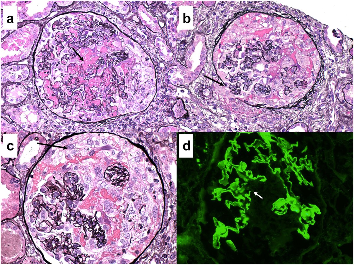Happy Tuesday! Check out "Avacopan in Patients With Rapidly Progressive Glomerulonephritis Requiring Dialysis" with Dr. Santoriello from Columbia's Renal Pathology Department as a coauthor
kireports.org/article/S2468-…