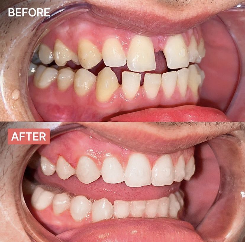 Ready to experience the remarkable evolution of your smile?😮

Check out this patient’s tremendous transformation after 10 months!🙌🏻