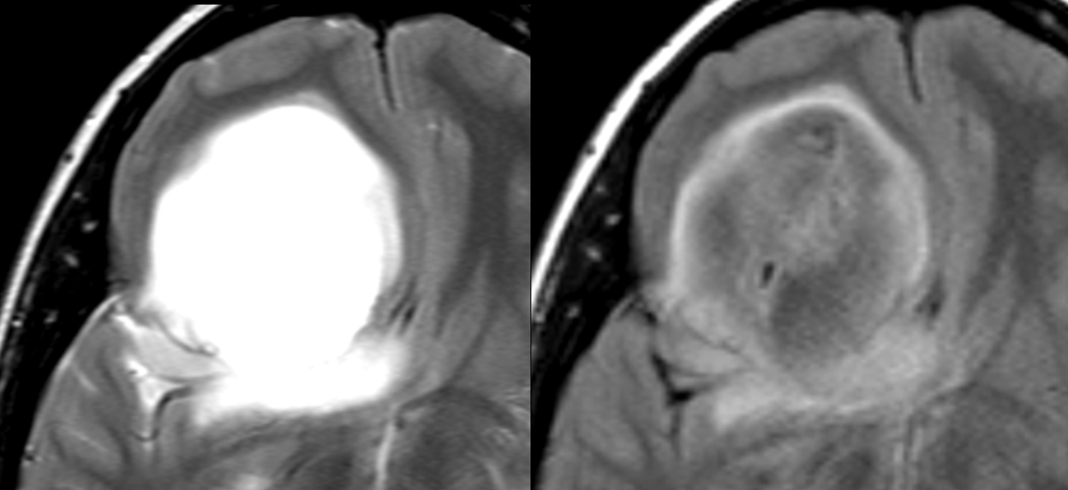 ecalabr's tweet photo. Regarding T2/FLAIR mismatch (incl. partial) in context of WHO2021:
1) it only applies to non-enhancing solid tumor components
2) it is specific for diffuse astrocytoma grade 2-4 versus oligodendroglioma/glioblastoma, NOT other tumors
3) it is NOT sensitive for IDH mutant status https://t.co/fPUGyvOkub
