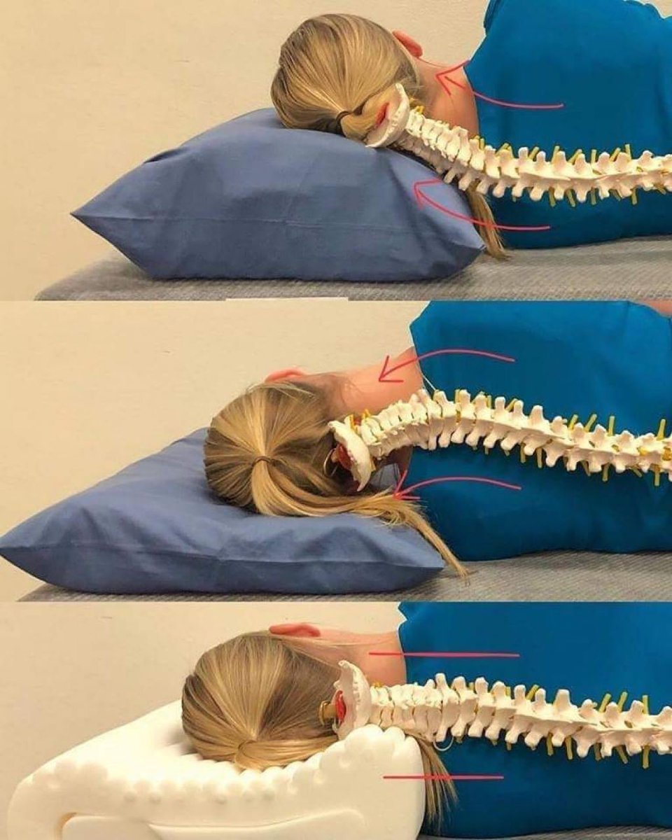 Yanlış yastık kullanımı omurganın normal pozisyonunu bozar ve şikayetlere neden olur. Doğru yastık seçimi en alttaki gibi olmalı.
#saglıklıyasam