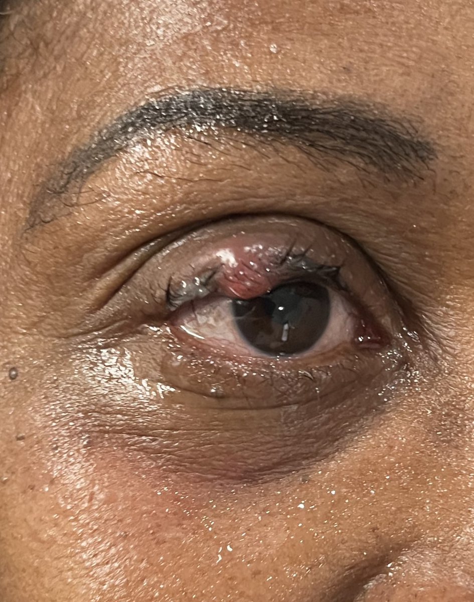 CastleHillsEC's tweet photo. Stye or Chalazion? After 1 Treatment Its Completely Gone! 
Our New Revolutionary Procedure Forma-I!
#castlehillseyecare #eyecare #carrollton #texas #chalazion #eyes #eyehealth #health #healthcare https://t.co/FSt15YaXJJ