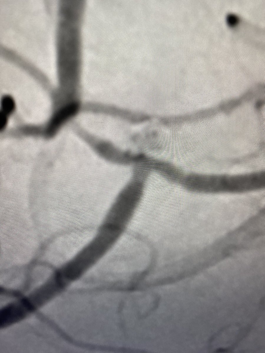 Boise Neurointervention (@stlukesnir) on Twitter photo Holy ant-man! Unruptured A2 bifurcation microlobulated aneurysm treated with a single <a href="/Stryker_NV/">StrykerNeurovascular</a> #Tetra coil. ๐ ๐ <a href="/EricRSmithMD/">Eric R Smith</a> Holy ant-man! Unruptured A2 bifurcation microlobulated aneurysm treated with a single <a href="/Stryker_NV/">StrykerNeurovascular</a> #Tetra coil. ๐ ๐ <a href="/EricRSmithMD/">Eric R Smith</a>
