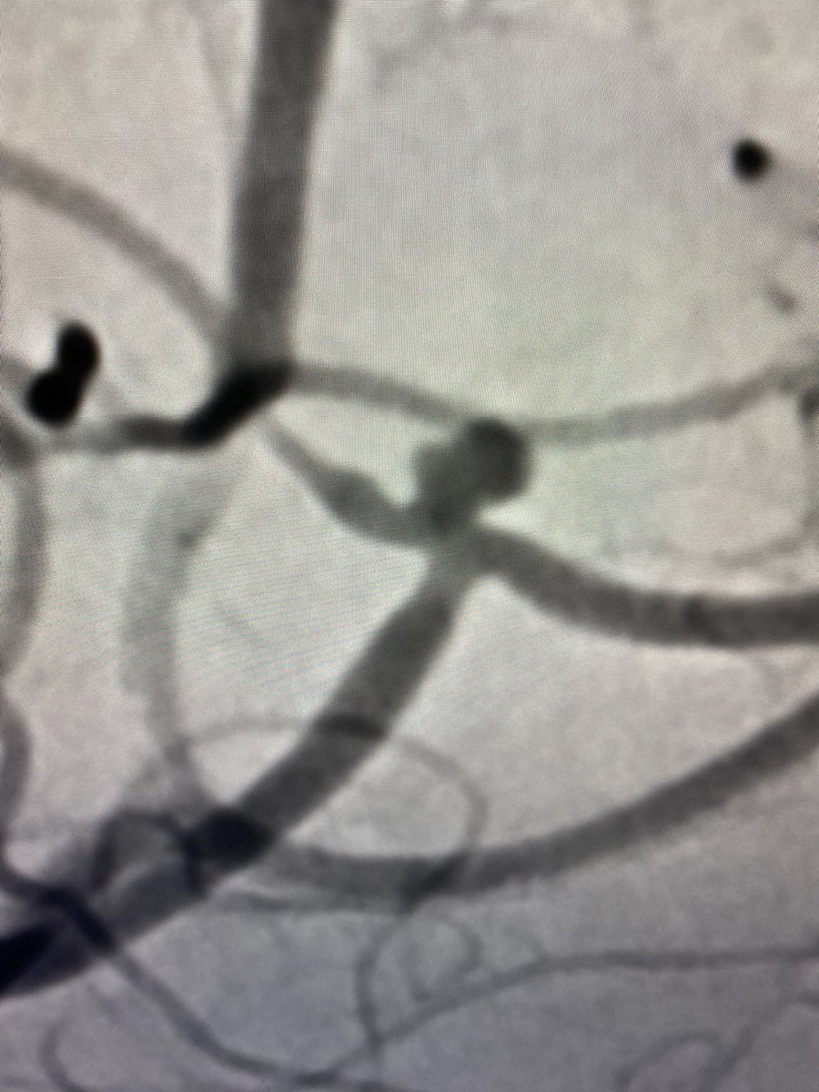 Boise Neurointervention tweet media