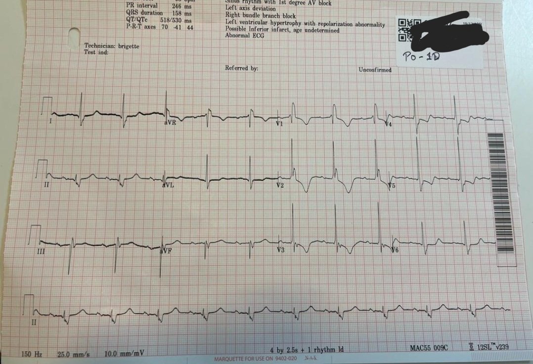 AlkashkariWail's tweet photo. At King Faisal Cardiac Center
70y, severe AS, Severe MR, mod to severe TR,PASP70 mmHg, RBBB, Declined surgery.
TAVI with high implant achieved with precision #evoluteFX 23mm, #cuspoverlap #commisural_alignment
The MR became mild the TR moderate, PASP 40 & no ECG changes
@AlrahimiJ @bogamisa @mirvatalasnag @Nabeelosis @MosaAbbadi1 @DrLeventoz