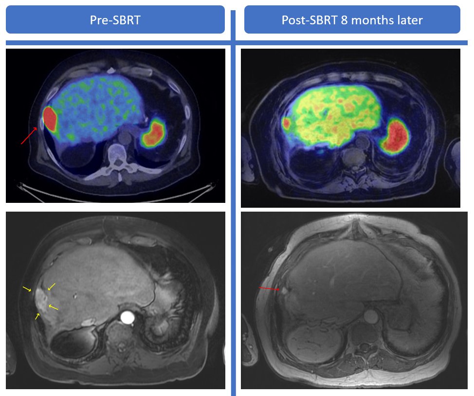 Thor Halfdanarson (@oncothor) on Twitter photo SBRT for malignant insulinoma... Refractory hypoglycemia + oligomet liver progression. Prior hepatic artery embolizations effective but no longer. On SSA, intolerant to everolimus.
50 Gy SBRT to the prog liver lesions with complete resolution of hypoglycemia. <a href="/PatrickMcGarrah/">Patrick McGarrah, MD</a> SBRT for malignant insulinoma... Refractory hypoglycemia + oligomet liver progression. Prior hepatic artery embolizations effective but no longer. On SSA, intolerant to everolimus.
50 Gy SBRT to the prog liver lesions with complete resolution of hypoglycemia. <a href="/PatrickMcGarrah/">Patrick McGarrah, MD</a>