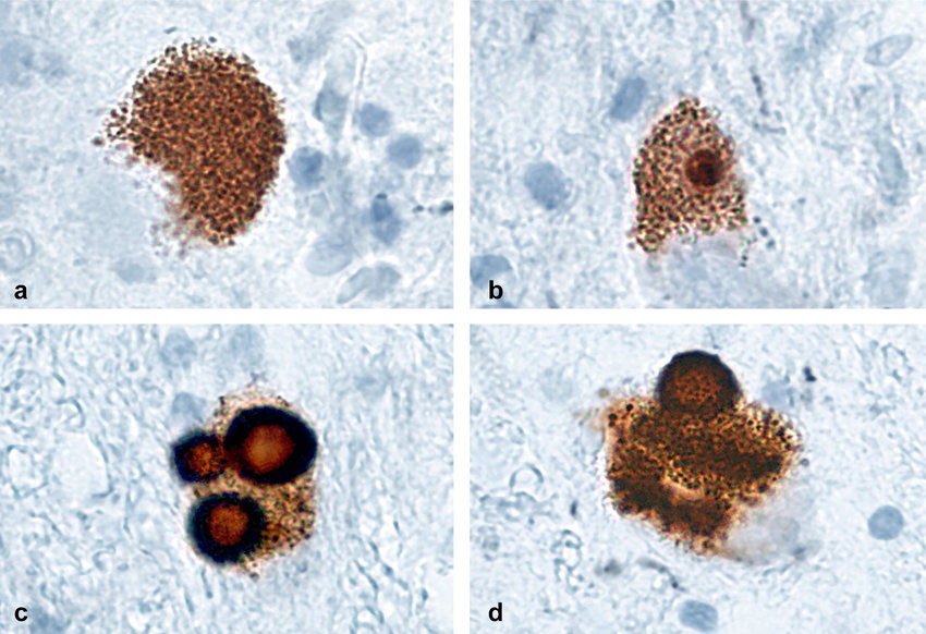 We know that neuromelanin is the type of melanin largely responsible for the nervous system 

So this begs the question: 

How many nervous system disorders can be traced back to neuromelanin dysfunction at its root?

• Alzheimer’s 
• Parkinson’s
• Multiple Sclerosis
•
