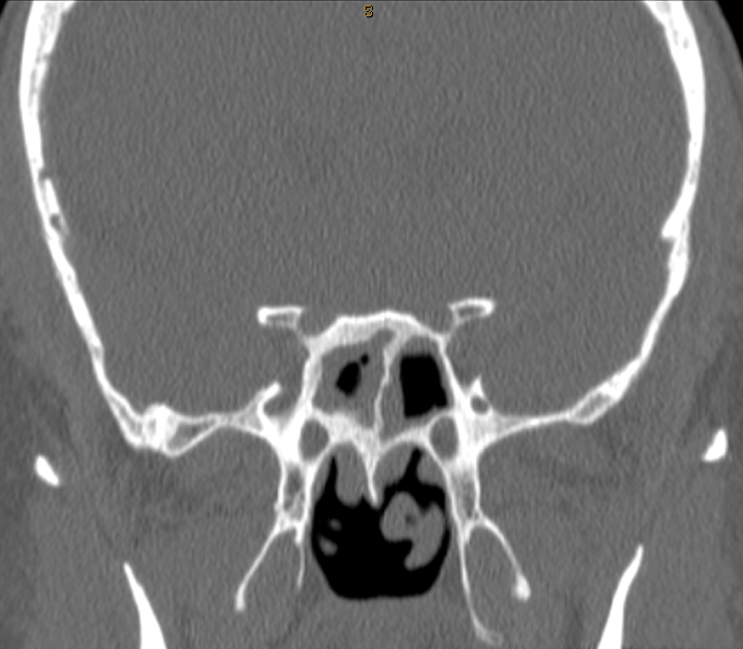 DrScottFortune's tweet photo. 2 yr h/o right sided nasal obstruction and "pressure" behind eyes. Comment your diagnosis and treatment plan below #rhinology #ctscan #SinusCTscan #nasalobstruction https://t.co/EZ3Kld4DOK