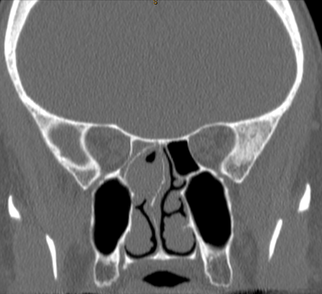 DrScottFortune's tweet photo. 2 yr h/o right sided nasal obstruction and "pressure" behind eyes. Comment your diagnosis and treatment plan below #rhinology #ctscan #SinusCTscan #nasalobstruction https://t.co/EZ3Kld4DOK