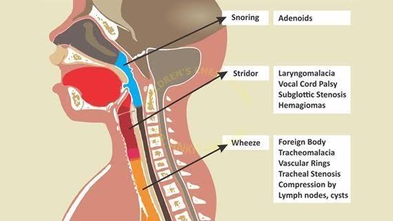 lFzRl's tweet photo. #Stridor is an #abnormal, high-pitched #respiratory sound that can be assessed during #breathing.
Stridor usually indicates an #obstruction or narrowing in the upper #airway, outside of the #chest cavity

#MedTwitter #Medical
#Health
#medicaleducation https://t.co/Ol5MSSbD2e