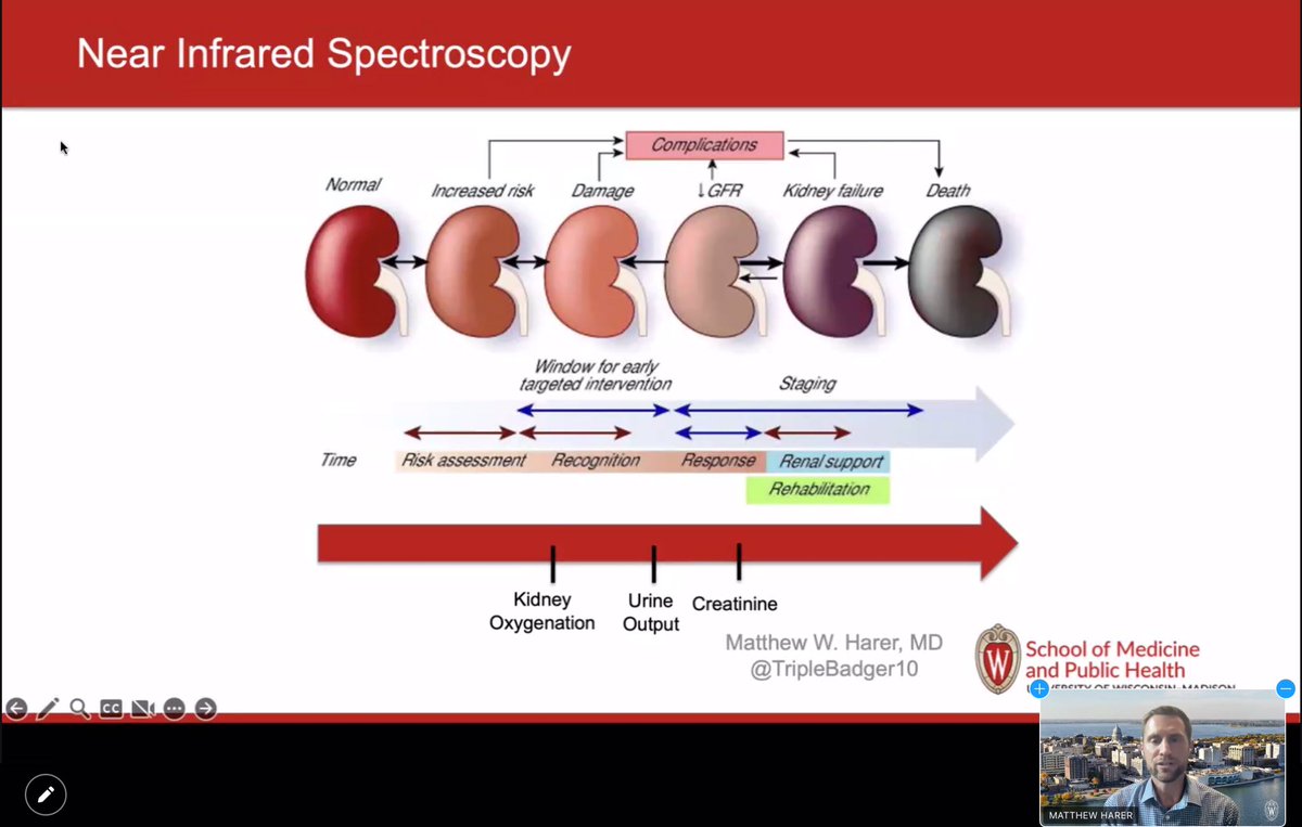 songMD's tweet photo. 2-3 x ⬆️ AKI risk in preterm infants- with higher risk at lower GA
How does NIRS help identify at risk infants?
Renal oxygenation changes precede UOP/Cr changes- ⬆️ risk with ⬆️⬆️ cumulative time <50% renal saturation
#CANcoolneo https://t.co/hy8PNQPGHa