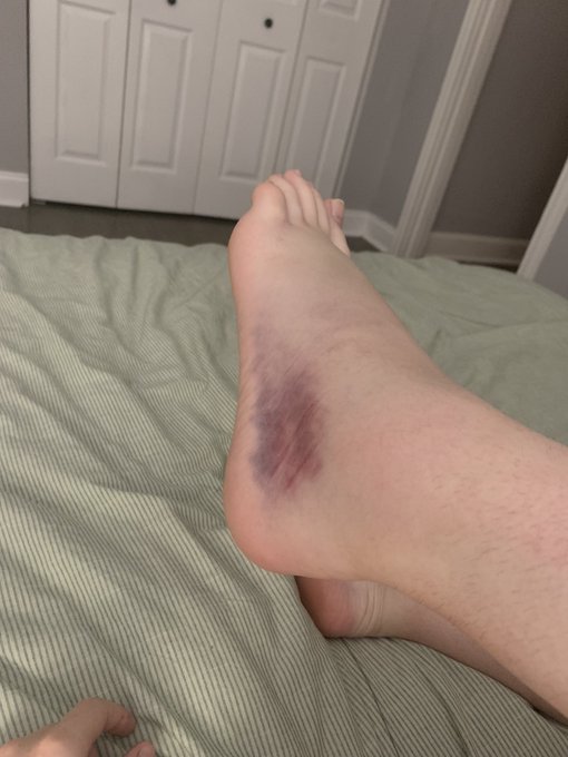 CW: bruising and swelling  OWIEEEE OUCH OUCH OW OW 🤕 https://t.co/A7TvdMOigD