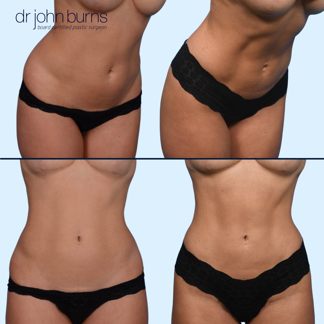 drjohnburns's tweet photo. 🪄1200cc of fat...GONE! This woman reached a plateau with working out and dieting. She was looking for a tighter, etched appearance to her midsection. Dr. Burns used #VASER ultrasound high-definition #liposuction to lean out and sculpt her waistline. #plasticsurgeon https://t.co/DoN9CKbXSo