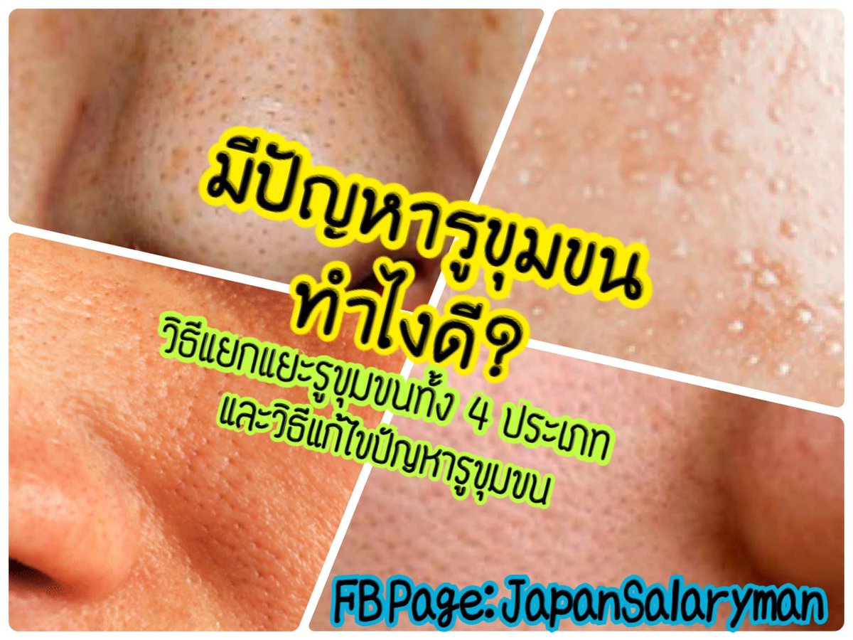 JapanSalaryboom's tweet photo. ใครมีปัญหาเกี่ยวกับรูขุมขน
โพสต์นี้จะมาแนะนำวิธีการแยกแยะรูขุมขนทั้ง 4 ประเภท (ลักษณะจะแตกต่างกันนะ) เพื่อจะได้เข้าใจและแก้ไขปัญหาให้ตรงจุด พร้อมวิธีแก้ไขที่ผมใช้เองและบางส่วนก็เรียนรู้มาจากรายการทีวีในญี่ปุ่นครับ
 
ใครสนใจอ่านเธรดนี้ แล้วลองเอาไปปรับใช้ดูนะครับ จะยาวนิดนึง
(1) https://t.co/CeaJeFYPvH