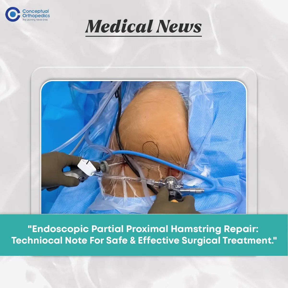 ConceptualOrtho's tweet photo. Conceptual Orthopedics brings you important Medical News. It will be beneficial to get a better understanding of the topics.

For Such Educational Content Keep Following @conceptualorthopedics

#conceptualorthopedics #orthopedics #medicalnews #orthoresidents #medicallearning https://t.co/acKRVKnIzJ